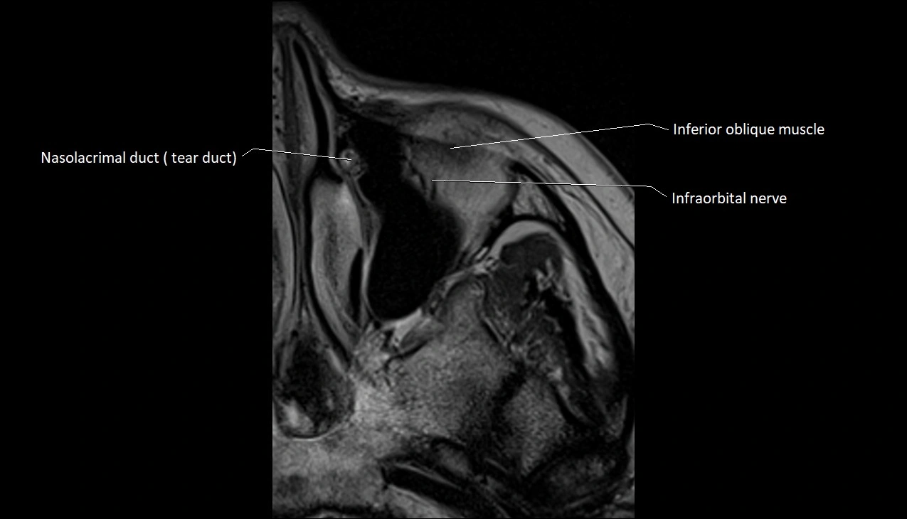 MRI Orbit axial cross sectional anatomy image 2.webp